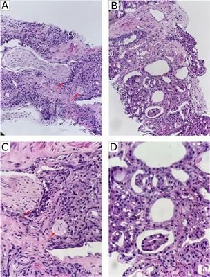 Preoperative Platelet Count Correlates With Postoperative Perineural Invasion on Specimen in Patients Treated With Radical Prostatectomy